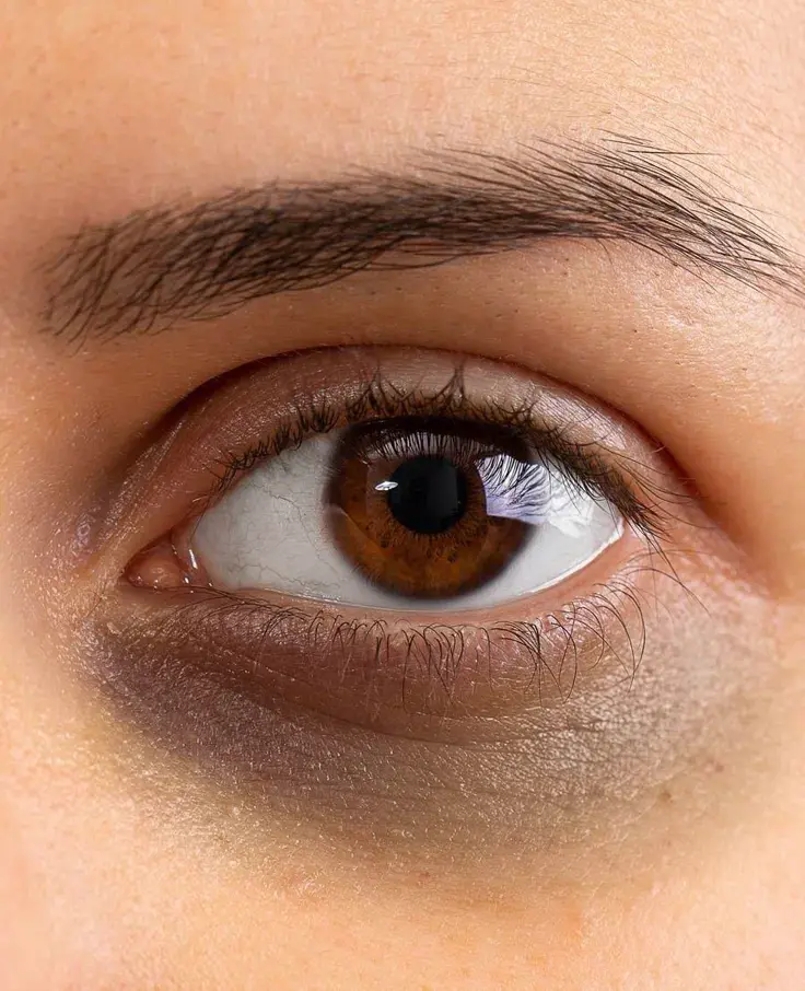 Dark Circles