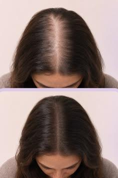 Hair Growth
